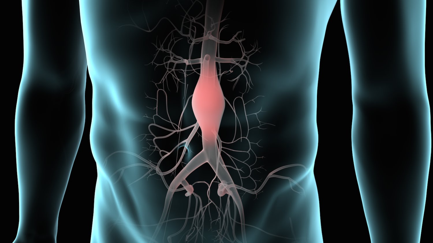 Anevrism de aortă abdominală: simptome, cauze, tratament