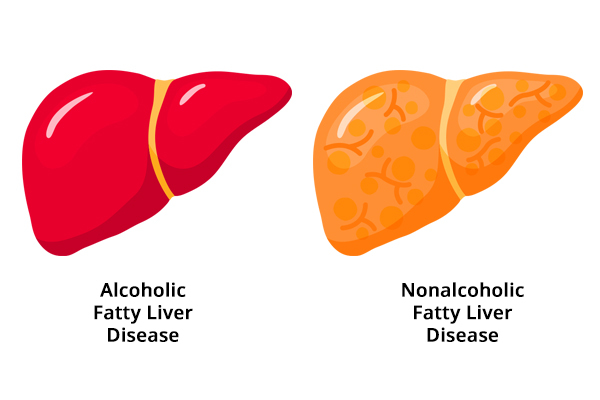Diferențele dintre boala ficatului gras alcoolic și nealcoolică