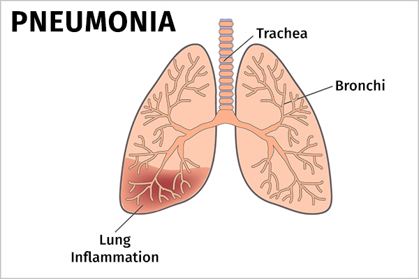 Pneumonia: Tipuri, simptome si schimbari in alimentatie