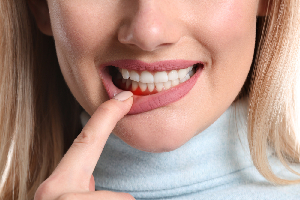 Sangerarea gingiilor si sangerarea dentara