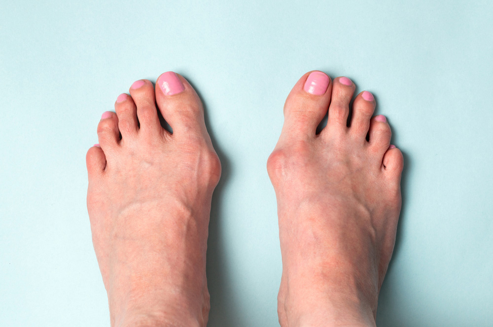Hallux valgus: deformarea primului deget de la picior