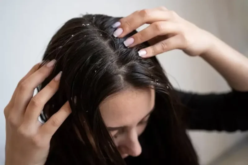 Remedii naturale pentru mătreață: Soluții eficiente pentru un scalp sănătos
